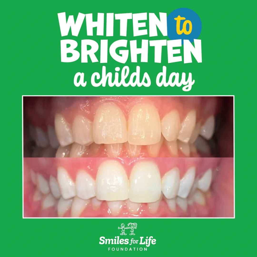 smiles for life before and after